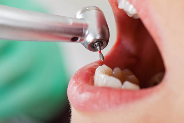 Best Emergency Wisdom Teeth Removal in Carbon Hill, AL